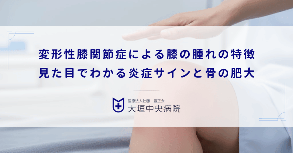 変形性膝関節症による膝の腫れの特徴｜見た目でわかる炎症サインと骨の肥大