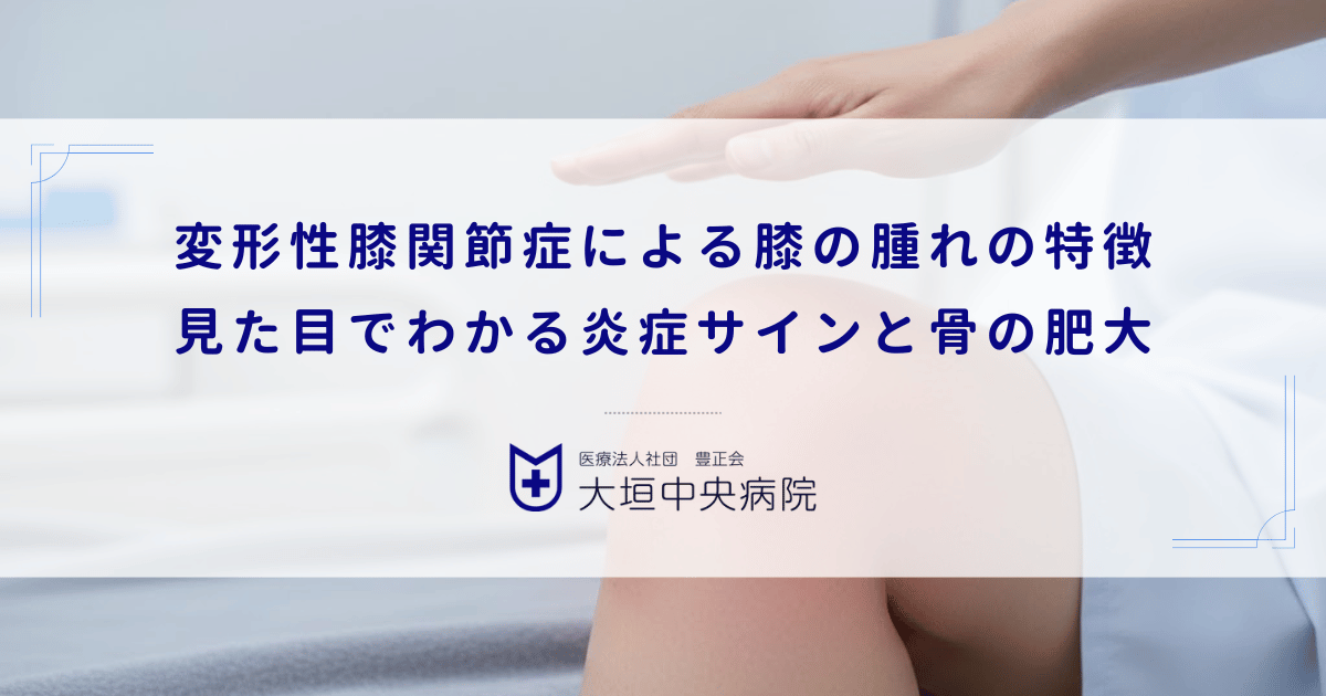 変形性膝関節症による膝の腫れの特徴｜見た目でわかる炎症サインと骨の肥大