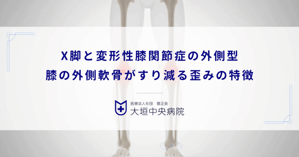X脚（外反膝）と変形性膝関節症の外側型｜膝の外側軟骨がすり減る歪みの特徴