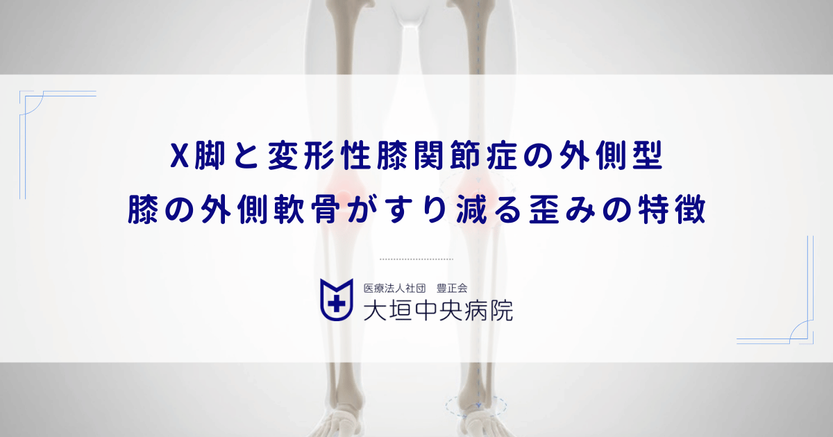 X脚（外反膝）と変形性膝関節症の外側型｜膝の外側軟骨がすり減る歪みの特徴