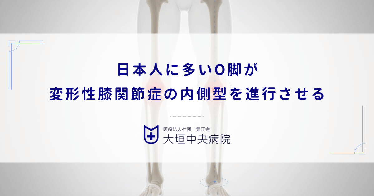 日本人に多いO脚（内反膝）が変形性膝関節症の内側型を進行させる力学的理由