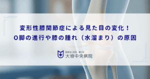 変形性膝関節症による見た目の変化！O脚の進行や膝の腫れ（水溜まり）の原因