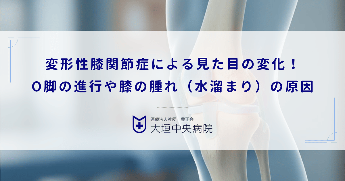 変形性膝関節症による見た目の変化！O脚の進行や膝の腫れ（水溜まり）の原因