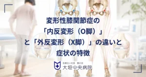 変形性膝関節症の内反変形（O脚）と外反変形（X脚）で荷重軸と傷む部位が変わることを示す医療イメージ