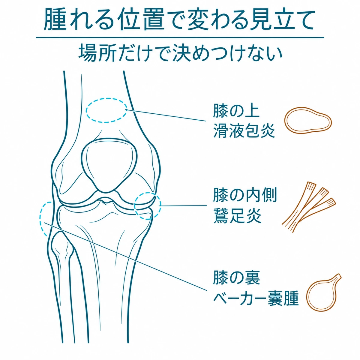 膝の上・内側・裏に生じる腫れと滑液包炎、鵞足炎、ベーカー嚢腫の関係を並べた部位別の図