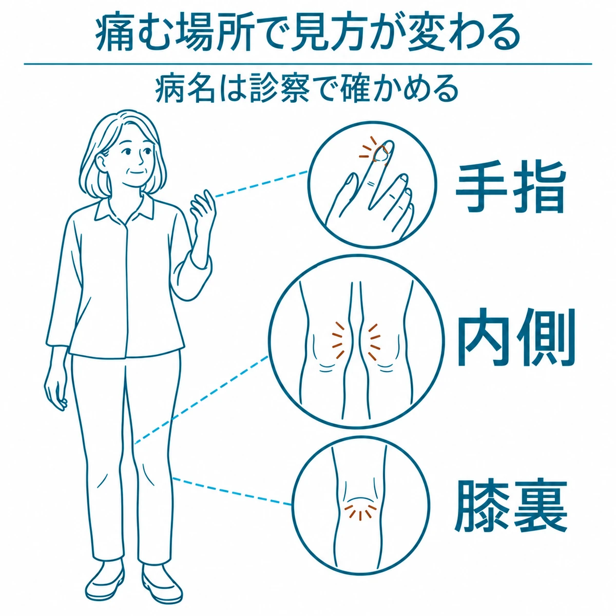 女性の手指、膝の内側、膝裏にみられる痛みの場所を示した図