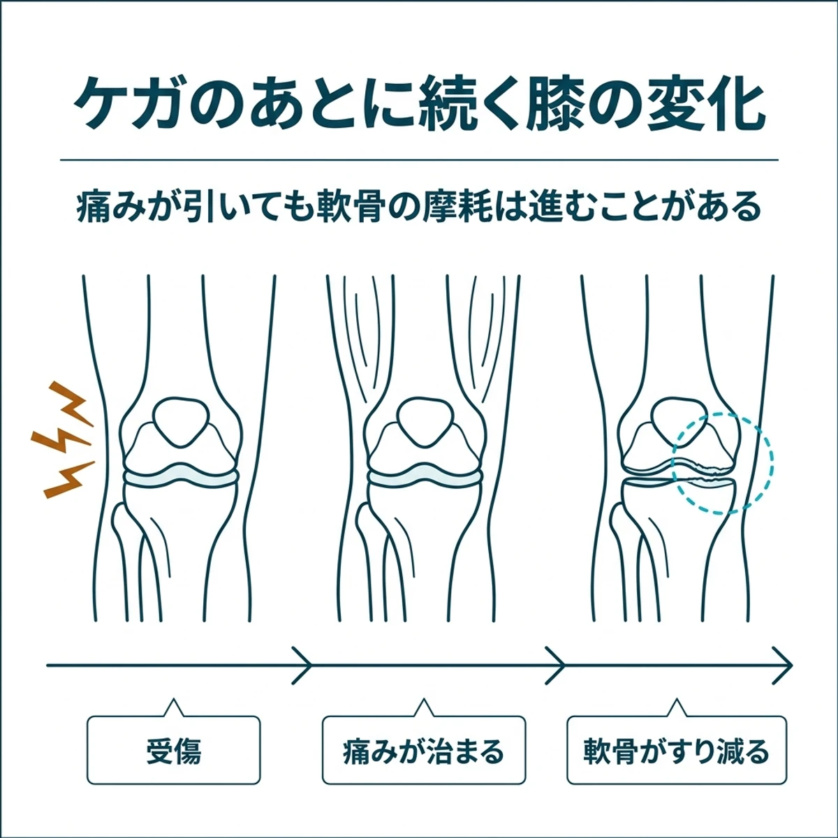 受傷後に痛みが治まったあとも年月をかけて膝の軟骨がすり減っていく経過を示したイラスト