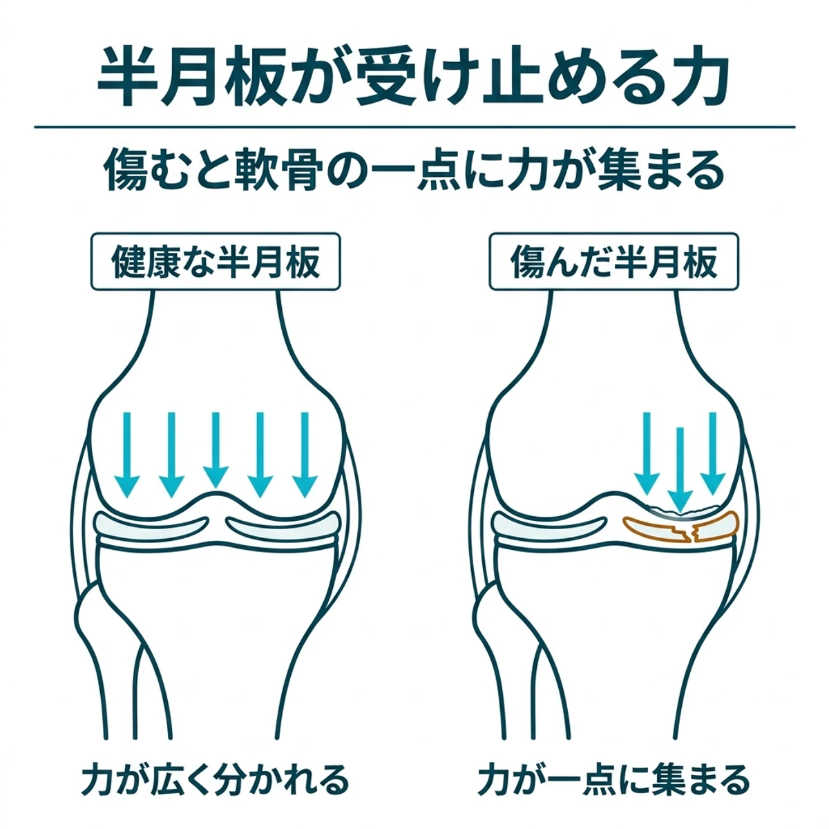 健康な半月板と傷んだ半月板で膝の軟骨への力の伝わり方を比べた対比図