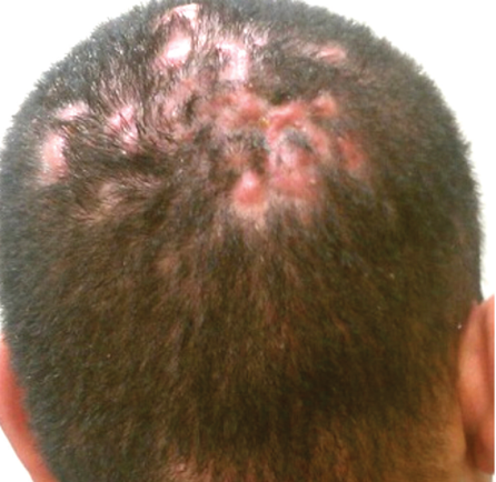 膿瘍性穿掘性頭部毛包周囲炎