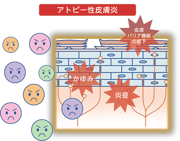 コレクチム軟膏（デルゴシチニブ）