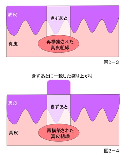 肥厚性瘢痕