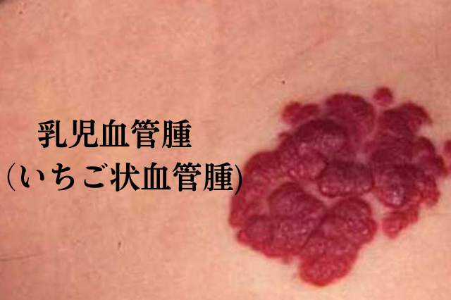 血管腫の治療選択肢