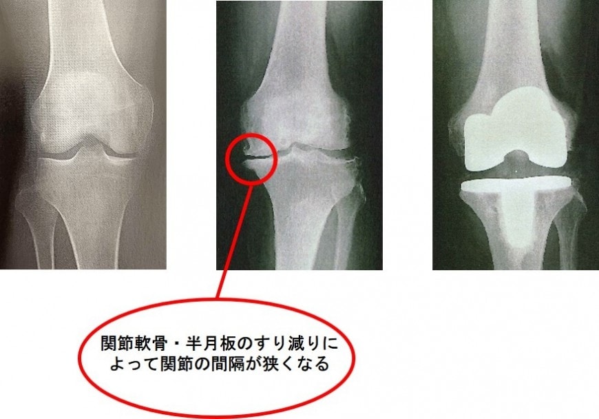 図１　膝のレントゲン
（引用：病気がみえる　運動器・整形外科　Vol.11）
