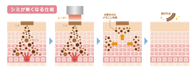 レーザーによるシミ治療の仕組み