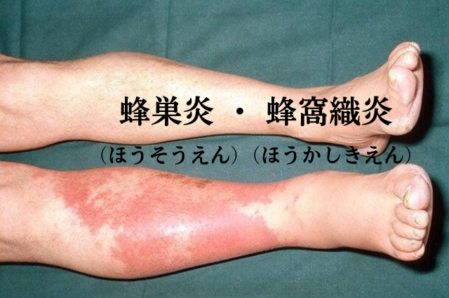  蜂巣炎（ほうそうえん）・蜂窩織炎（ほうかしきえん）｜こばとも皮膚科｜栄駅（名古屋市栄区）徒歩2分 Illustration 