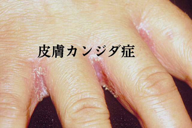 食道カンジダ症の治療