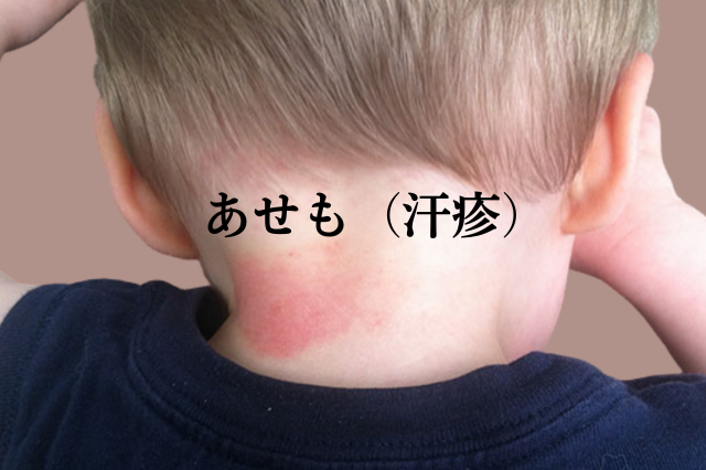 あせも 発疹 | あせも 湿疹 写真 | 『あせも(汗疹)』の原因・症状・治療法【症例画像】 – URFYQ
