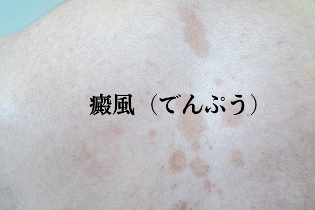 癜風(でんぷう)|こばとも皮膚科|栄駅(名古屋市栄区)徒歩2分