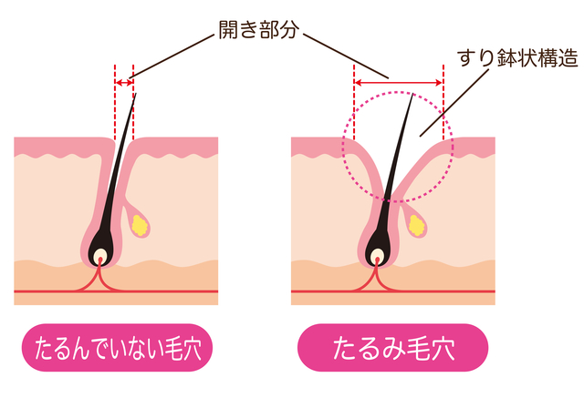 たるみ毛穴の構造