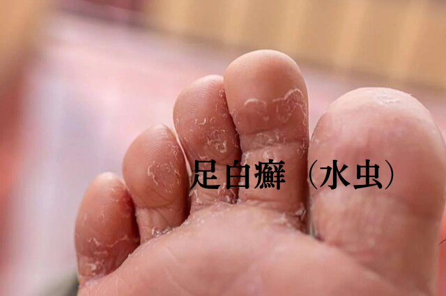 足白癬(水虫)|こばとも皮膚科|栄駅(名古屋市栄区)徒歩2分