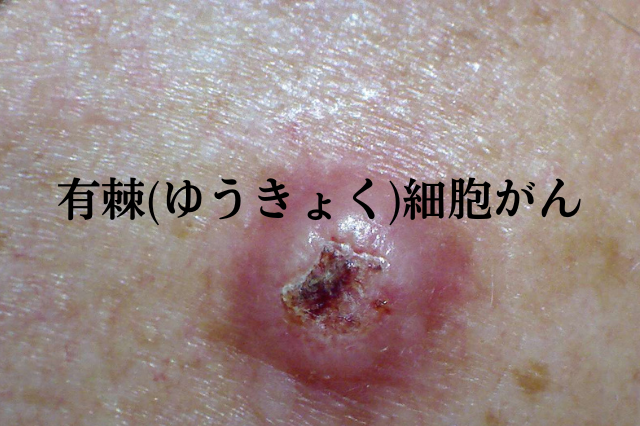 有棘(ゆうきょく)細胞がん|こばとも皮膚科|栄駅(名古屋市栄区)徒歩2分