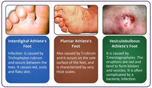 足白癬（水虫）｜こばとも皮膚科｜栄駅（名古屋市栄区）徒歩2分
