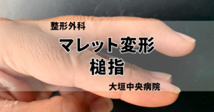 ばね指（弾発指） | 医療法人社団豊正会 大垣中央病院