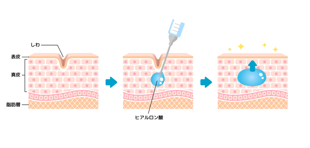 ヒアルロン酸注入の解説