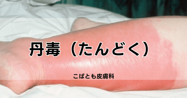 丹毒(たんどく)|こばとも皮膚科|栄駅(名古屋市栄区)徒歩2分