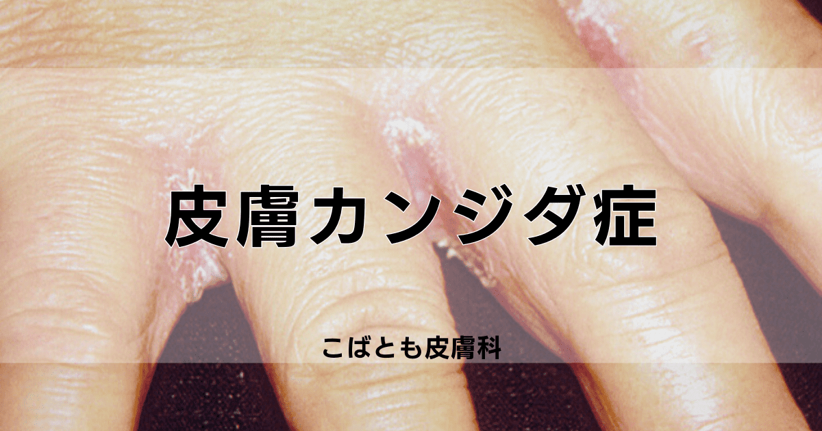 皮膚カンジダ症