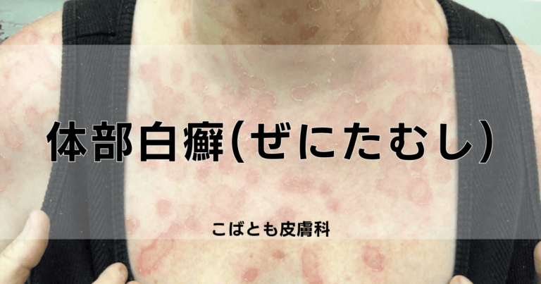 身体のある部分から別の部分にどのように広がるか