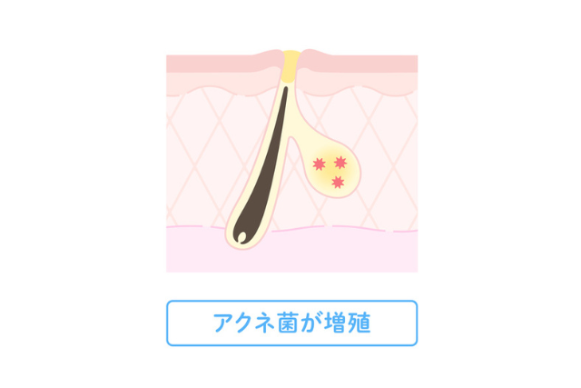 アクネ菌の増殖