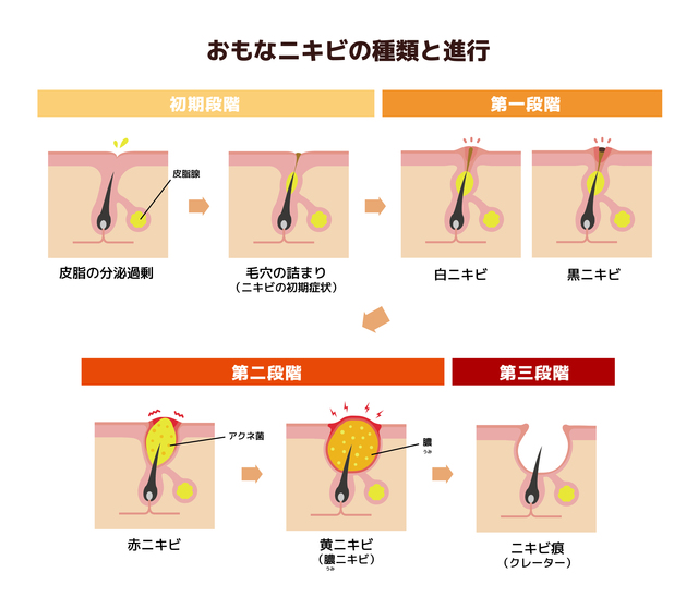 おもなニキビの種類と進行