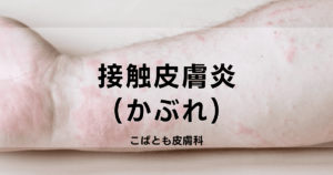 title-for-contact-dermatitis-