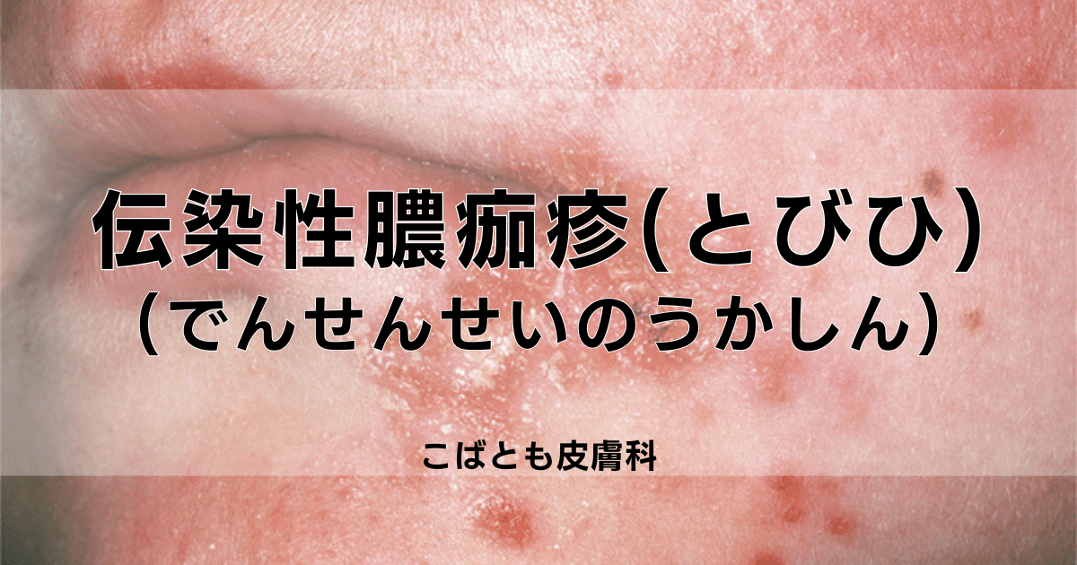 大腸菌の蔓延を防ぐには