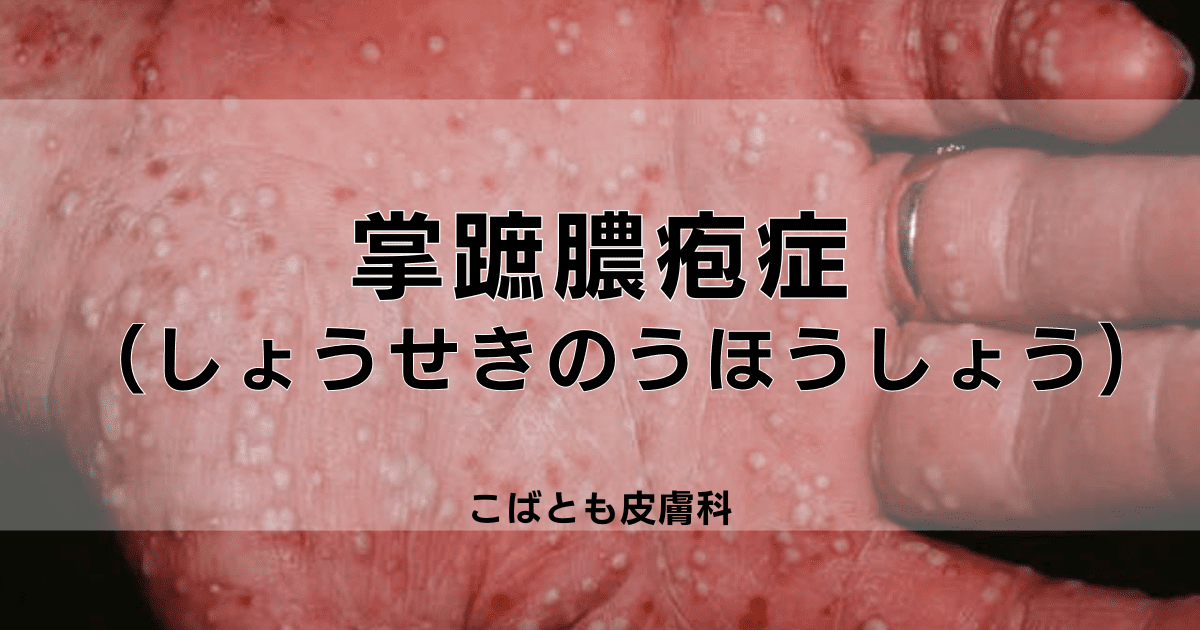 掌蹠膿疱症（しょうせきのうほうしょう）｜こばとも皮膚科｜栄駅（名古屋市栄区）徒歩2分