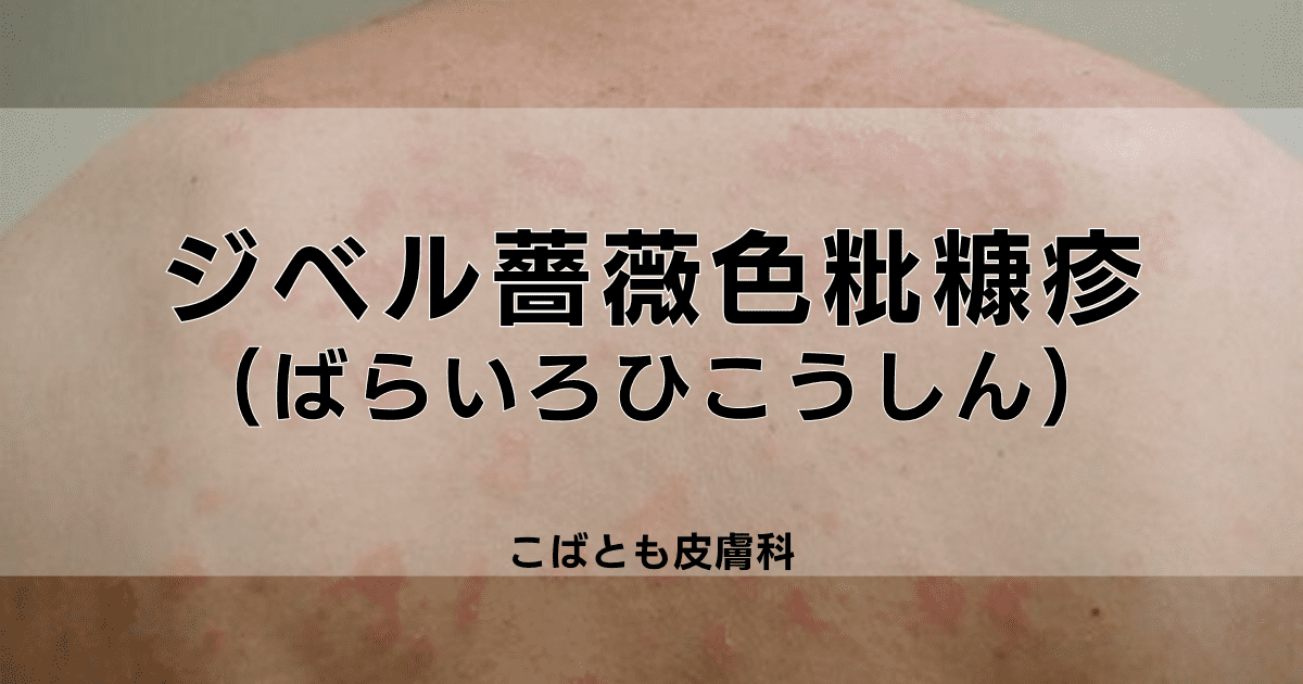 ジベル薔薇色粃糠疹　ばらいろひこうしん