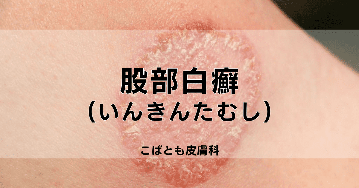 股部白癬 こぶはくせん いんきんたむし