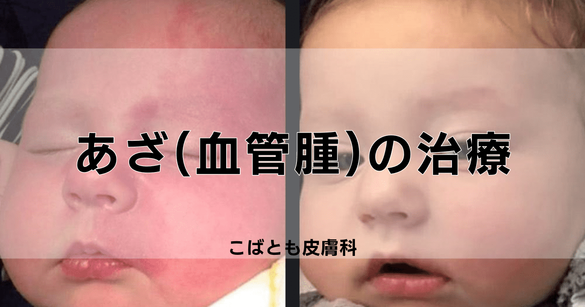 あざ（血管腫）の治療