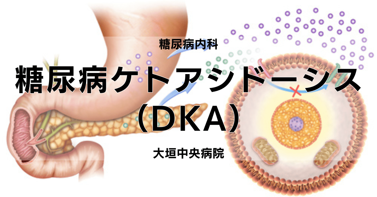 糖尿病ケトアシドーシス（DKA）