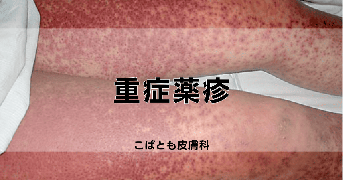 重症薬疹