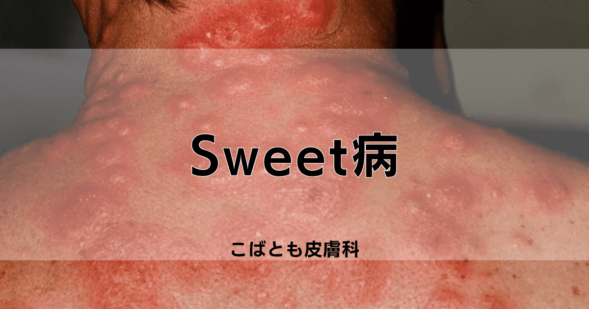 Sweet病