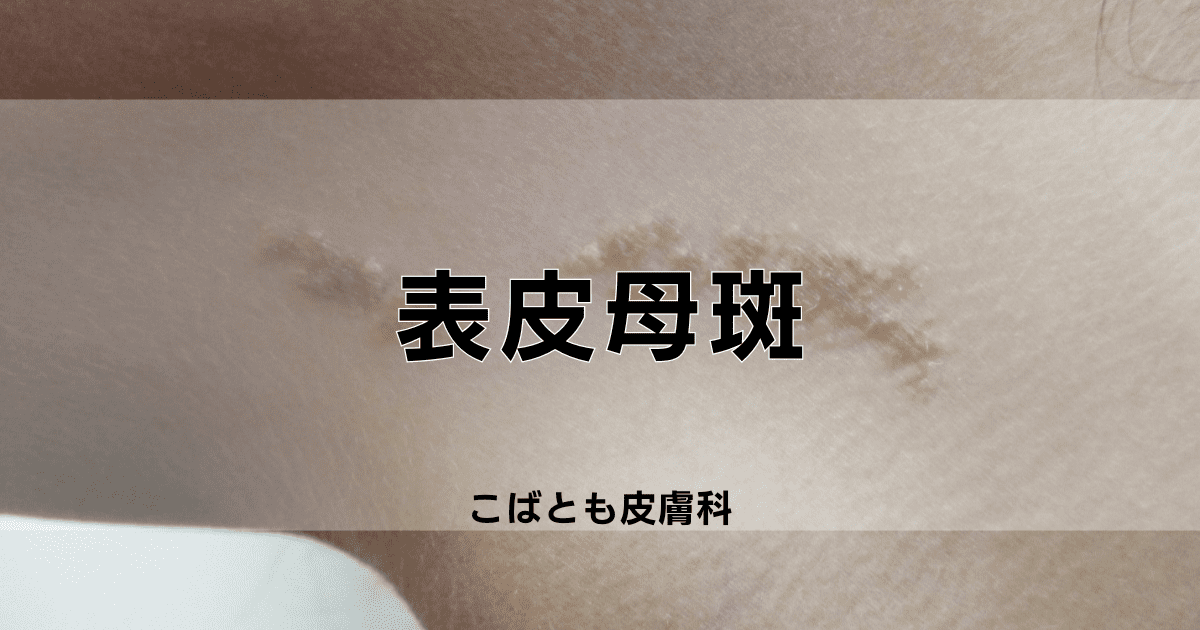 表皮母斑