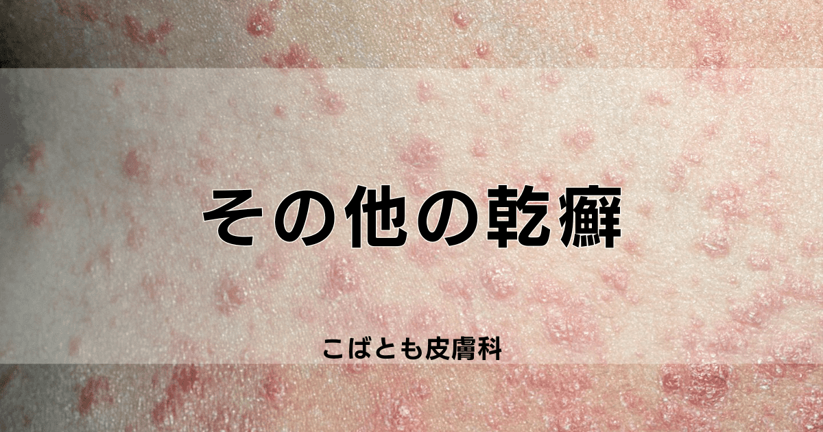 滴状乾癬、膿疱性乾癬、乾癬性紅皮症