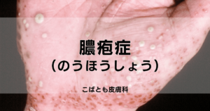 掌蹠膿疱症（しょうせきのうほうしょう）｜こばとも皮膚科｜栄駅