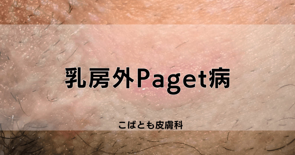 乳房外Paget病