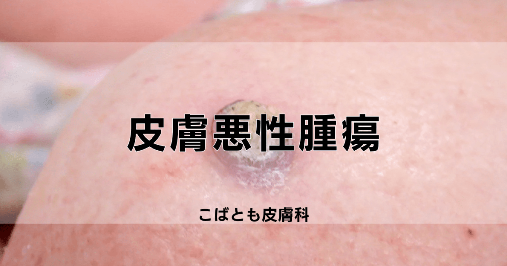 皮膚悪性腫瘍