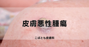 malignant-skin-tumors-title-