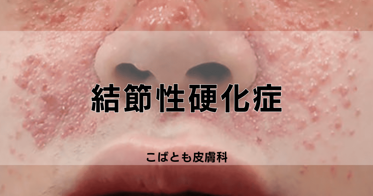 結節性硬化症