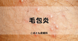 毛包炎｜こばとも皮膚科｜栄駅（名古屋市栄区）徒歩2分